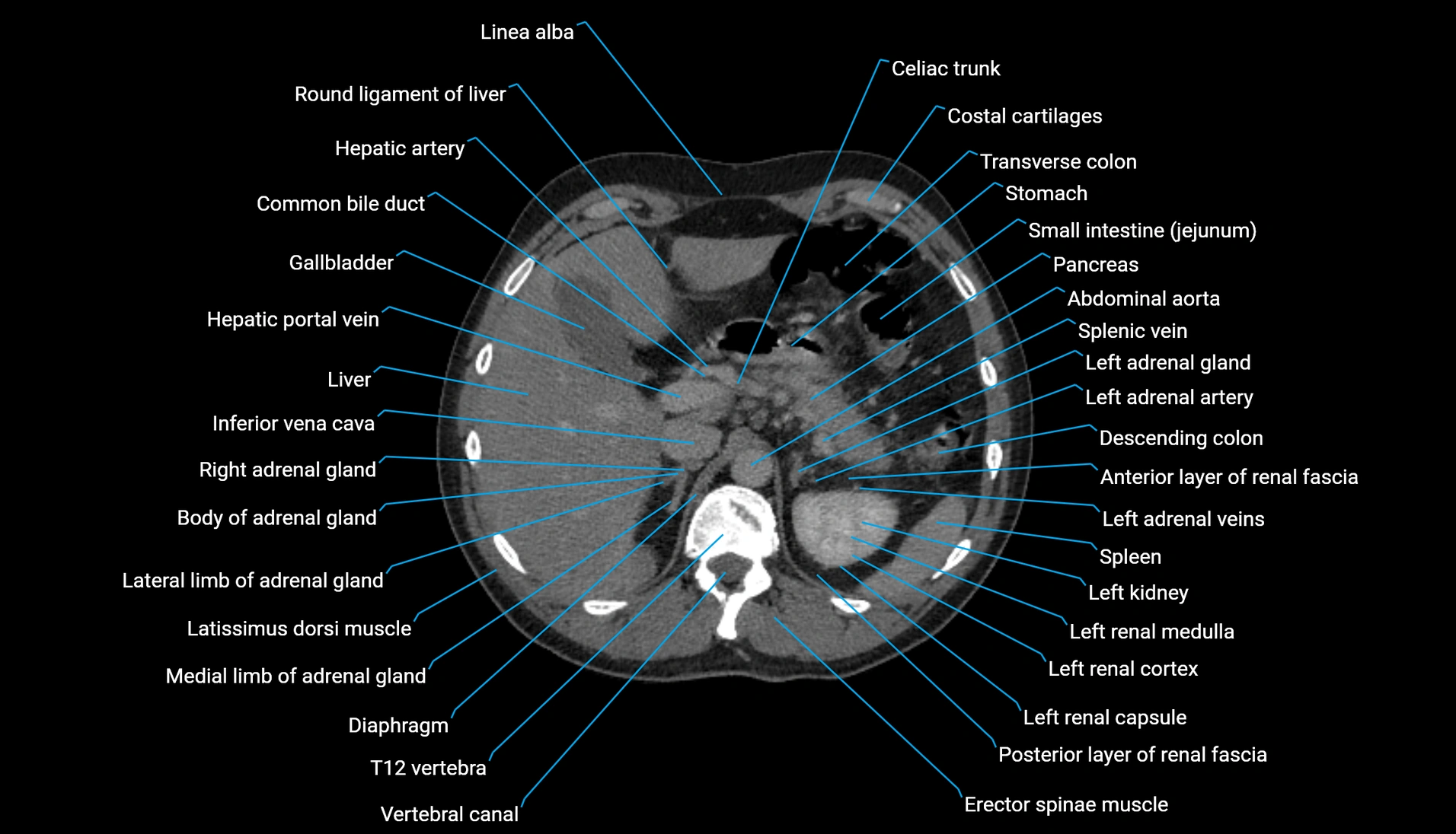 CT urogram axial cross sectional anatomy  labelled radiology image-00075.webp